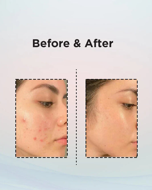 Anti Acne Cream