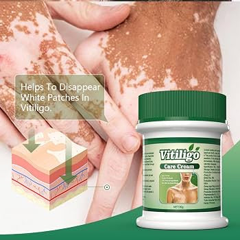 Vitiligo Herbal Aloe Vera & Mint Care Cream